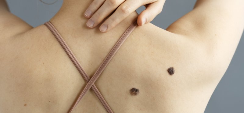 CAMPAÑA NACIONAL DE PREVENCIÓN DEL CÁNCER DE PIEL